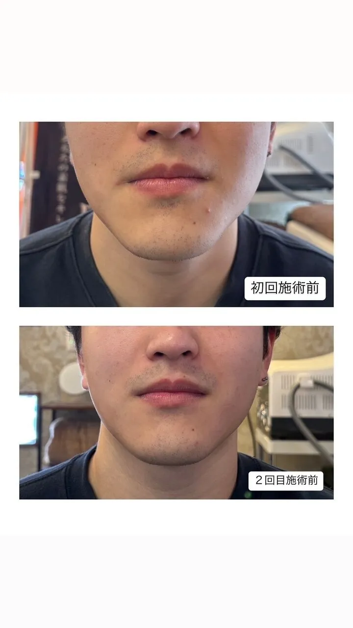 ヒゲ脱毛経過報告1-1
